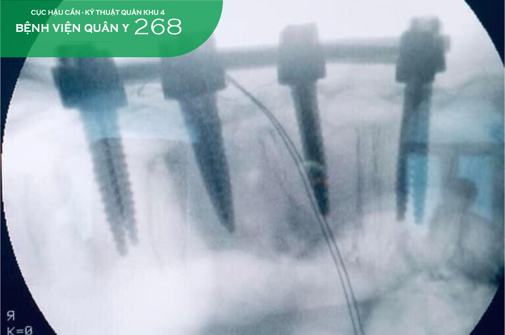NGÀY 29 TẾT, XUÂN GIÁP THÌN 2024 VỚI CA MỔ CHẤN THƯƠNG CỘT SỐNG GÃY LÚN D12, L1
